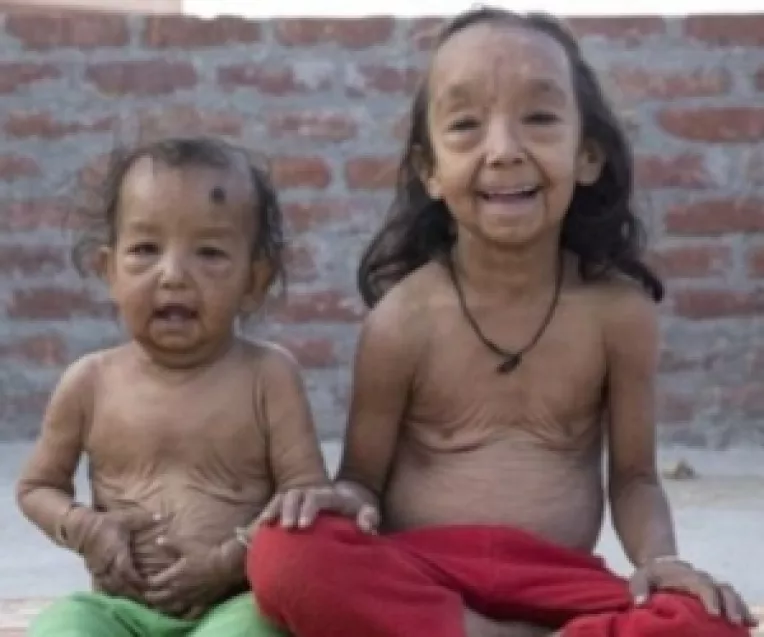 Doi copii din India arata ca doi pensionari din cauza unei boli extrem de rare de care sufera