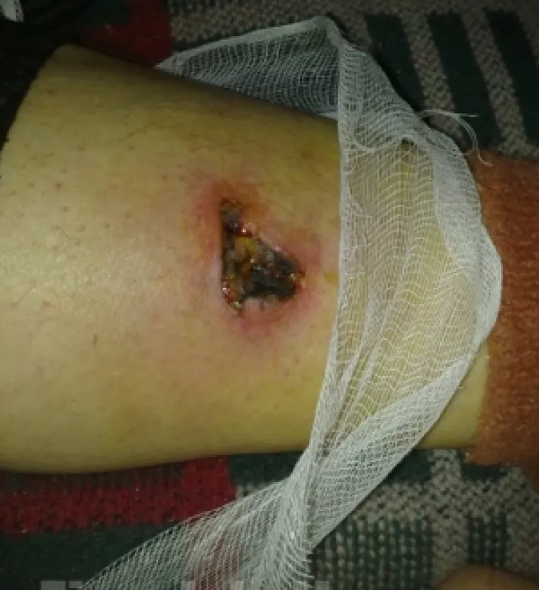 Doua femei din Timisoara au fost hacuite de o haita de 30 de caini salbaticiti