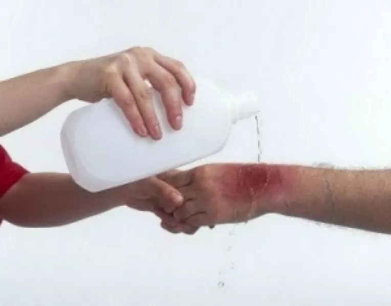 Remedii naturale pentru arsuri de mici dimensiuni