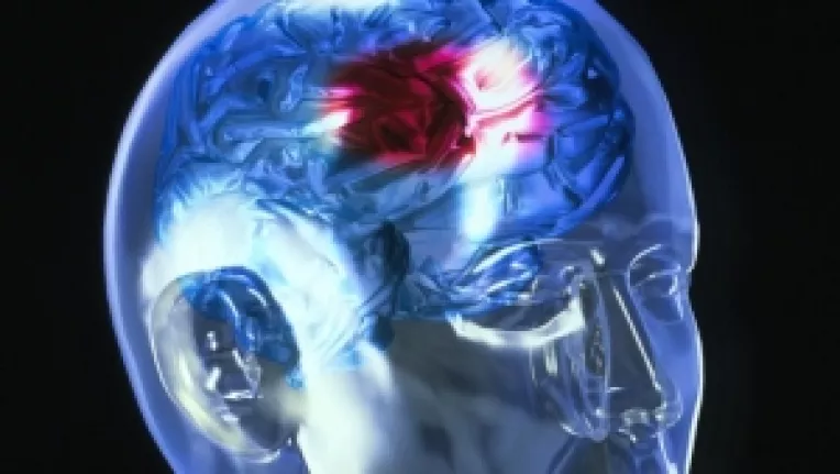 Simptomele accidentului vascular cerebral