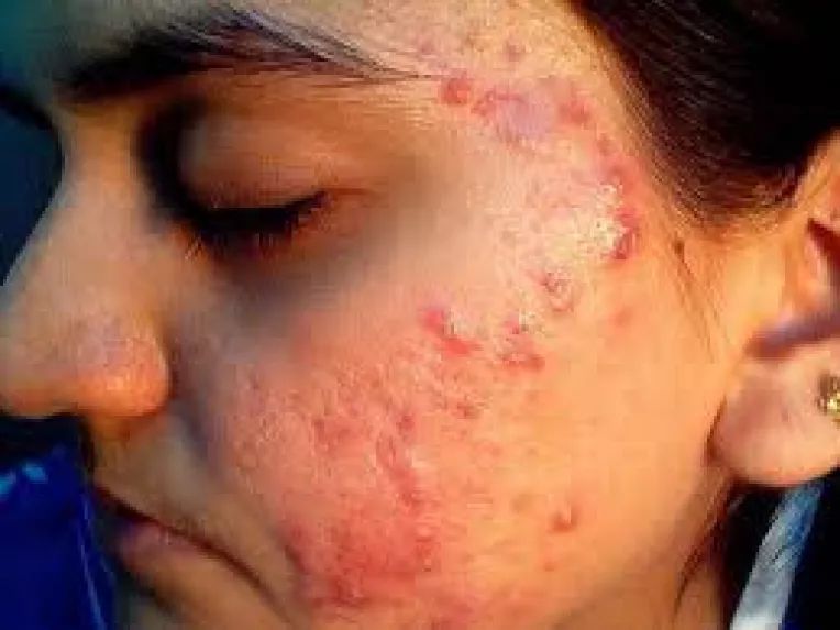 Solutii naturale pentru tratarea acneei