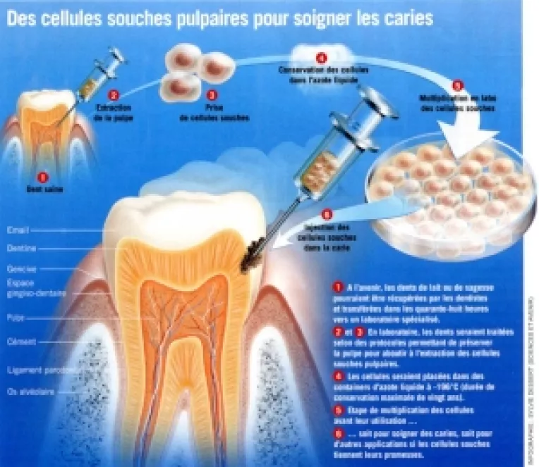 Universitatea Paris Descartes: Celulele suse vindeca leziunile dentare
